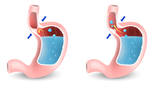 gastroezofagealen refluks