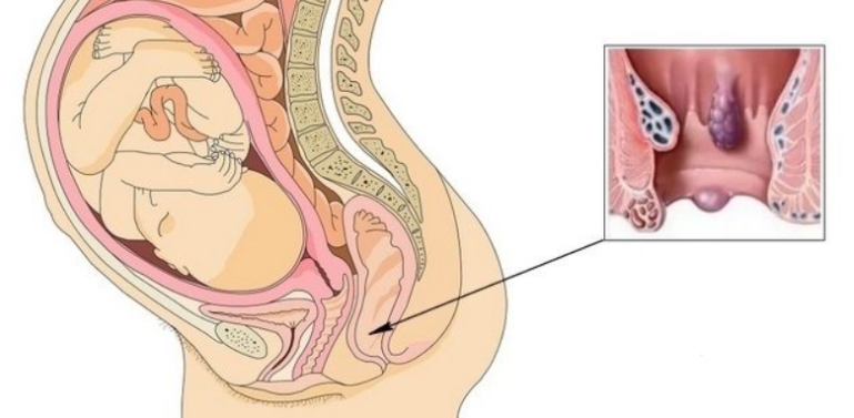 hemoroidi po vreme na bremennost