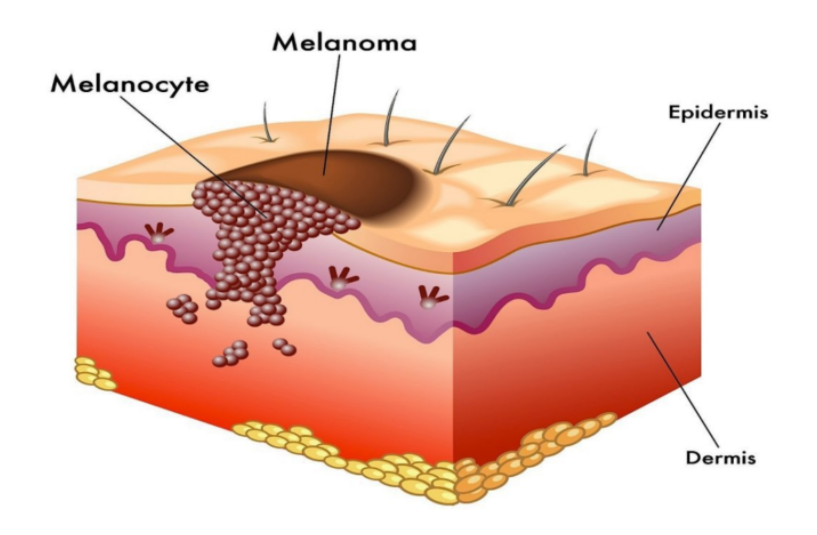 melanom