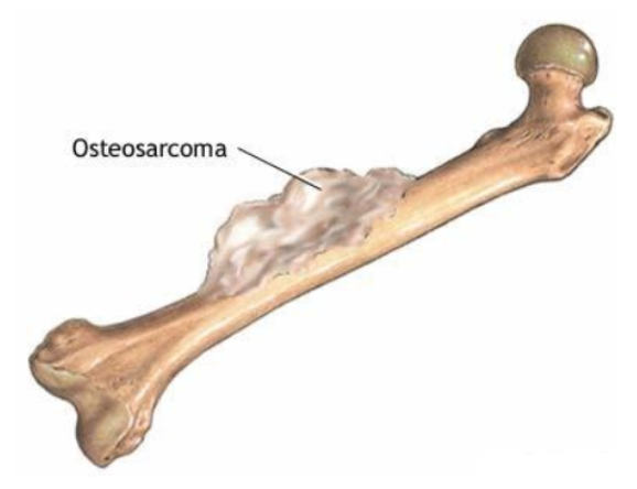 osteosarcoma