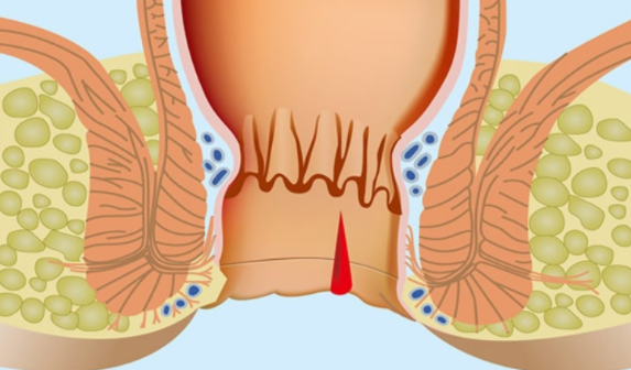 prichini hemoroidi