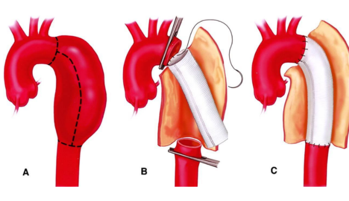 stent