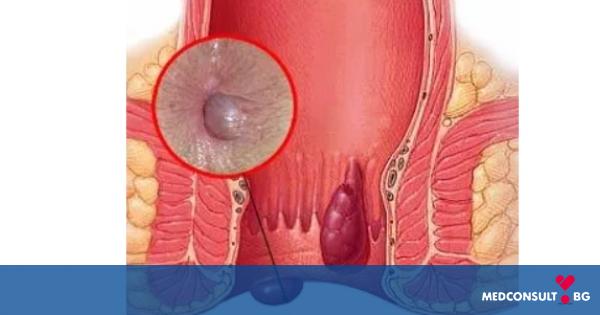 Най-разпространеното заболяване - хемороиди